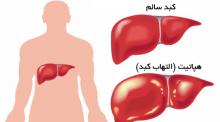 آسیب کبدی,علائم آسیب کبد,زردی,تهوع,shabnamha.ir,شبنم همدان,afkl ih,شبنم ها